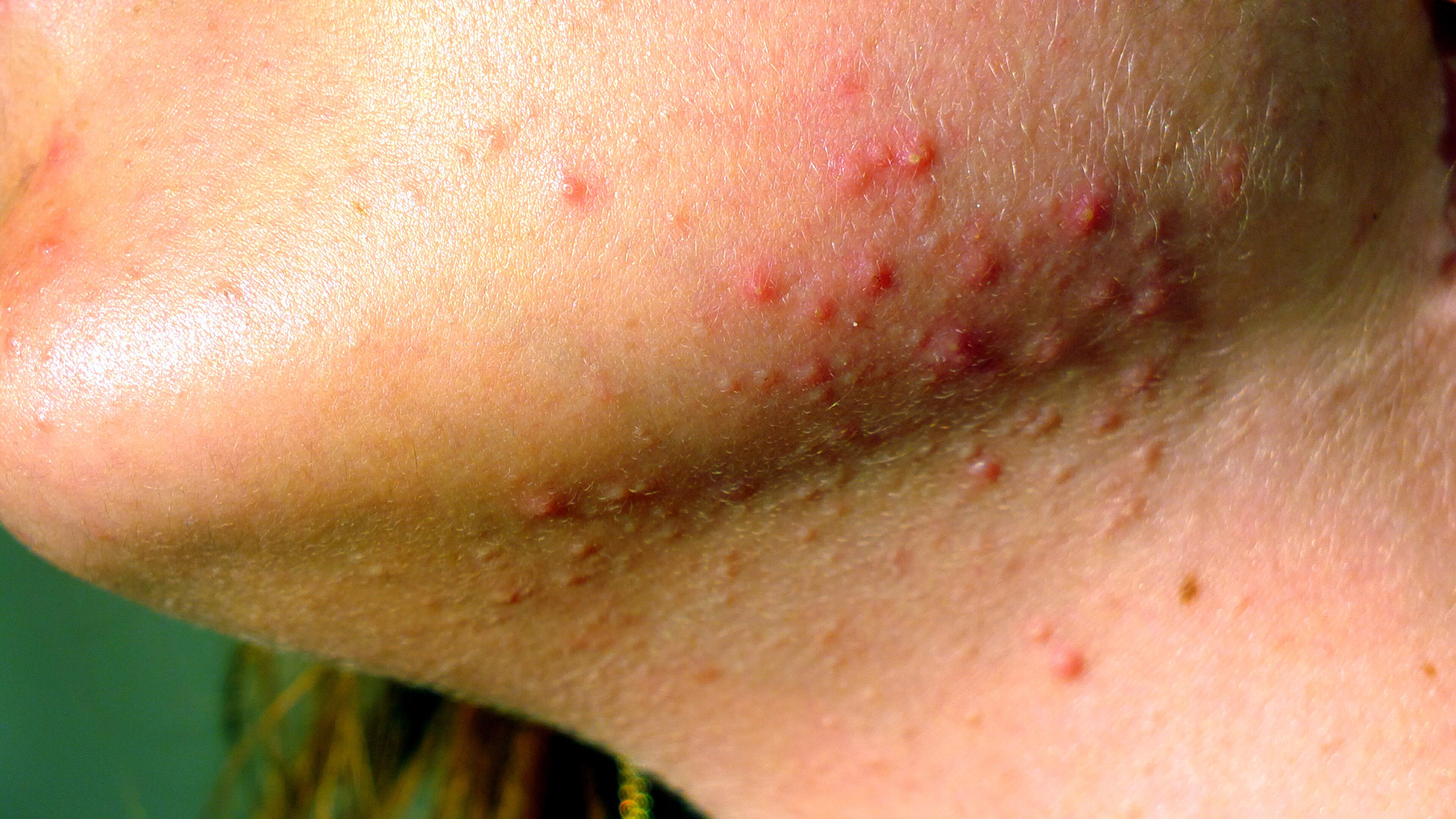 Investigadora de la UAA desarrolla tratamientos para prevenir alergias