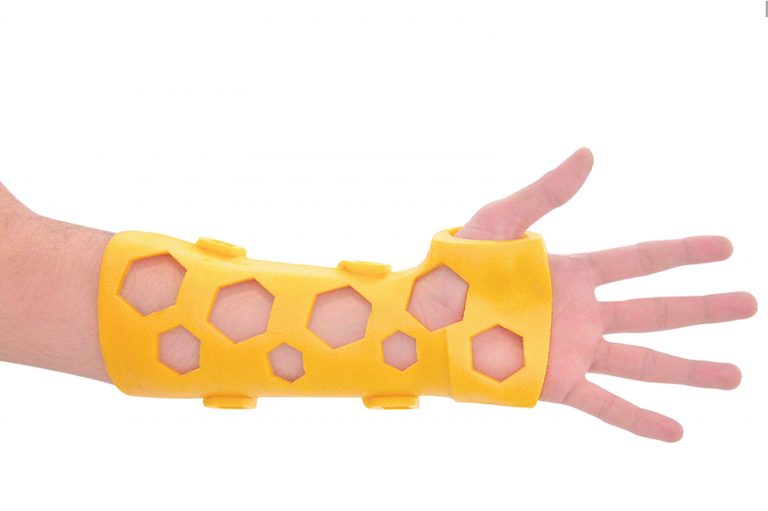 Crean sustituto de yesos con impresión 3D