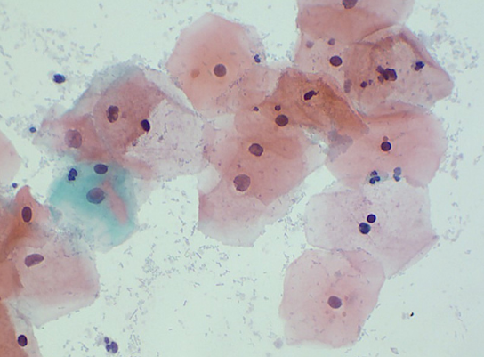 Papanicolaou puede detectar y tratar con éxito el cáncer cérvico-uterino si se realiza oportunamente