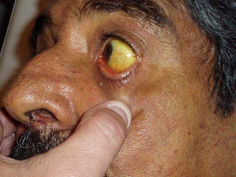 Impulsan programas de prevención para hepatitis