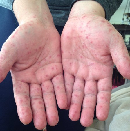 Descartan epidemia epidemiológica por coxsackie en el estado