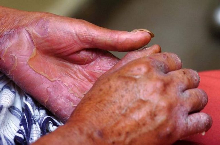 28 de enero, Día Mundial de la Lepra