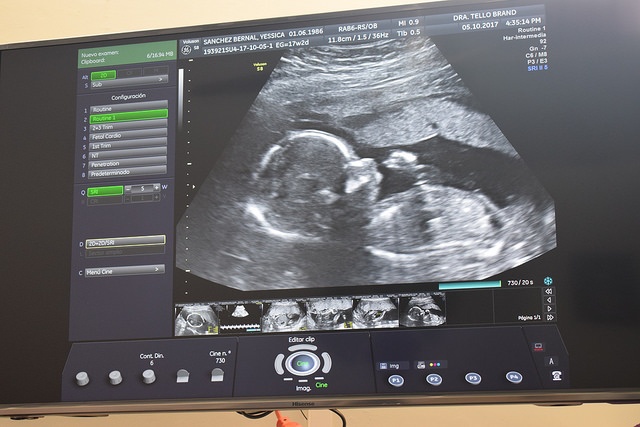 Tomar ácido fólico durante el embarazo previene defectos neurológicos en bebés