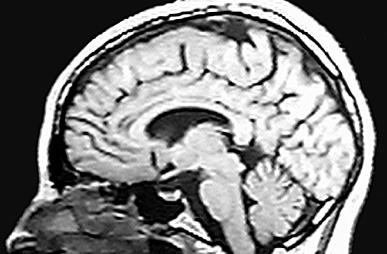 Donación de cerebro es trascendental tanto en lo social como para la medicina