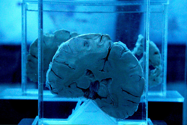 Se realiza en Aguascalientes la tercera donación de cerebro para investigaciones relacionadas con el Alzheimer