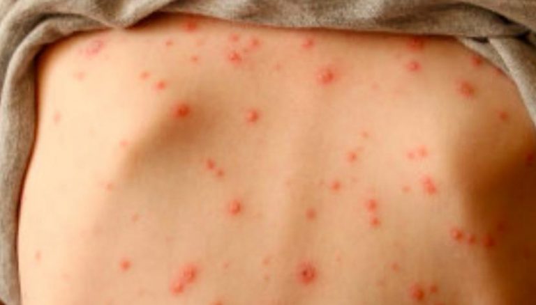 Aguascalientes en alerta por recientes brotes de sarampión en México