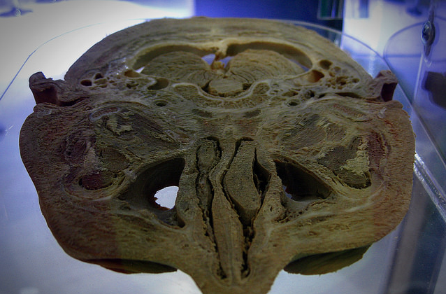 Banco de cerebros estudia similitudes en diferentes patologías neurológicas