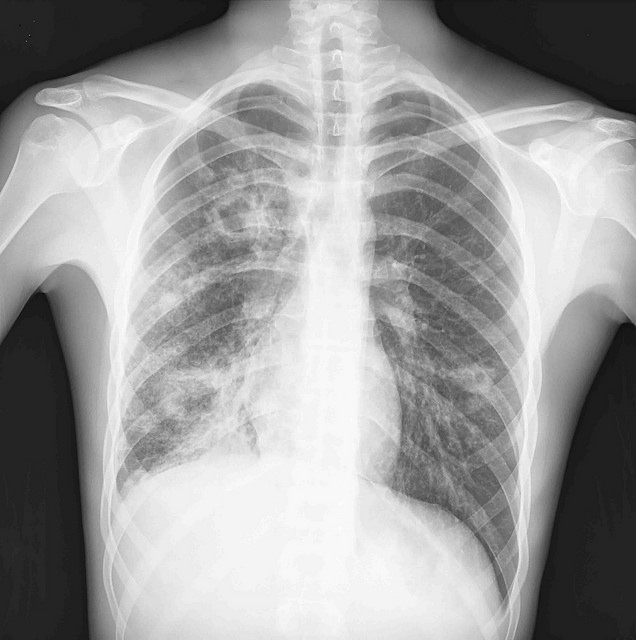 Es tuberculosis enfermedad infecciosa crónica más letal en el mundo