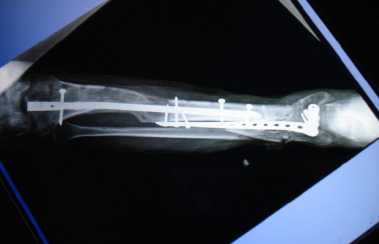 Utilizan técnica de alargamiento óseo en pacientes con fracturas expuestas