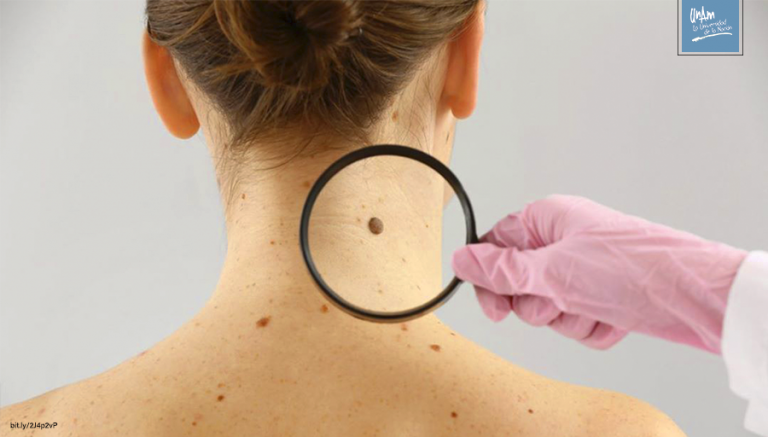 Aumentan casos de melanoma, responsable del 80% de muertes por cáncer de piel en México