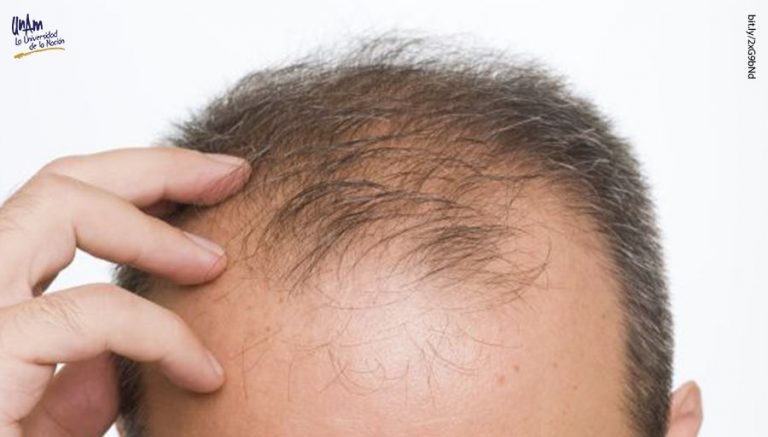 Calvicie afecta a cinco de cada diez hombres de 20 a 30 años de edad   