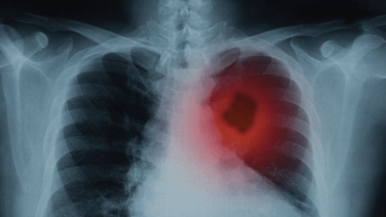 Falta avanzar en la medición de incidencia de cáncer de pulmón en México