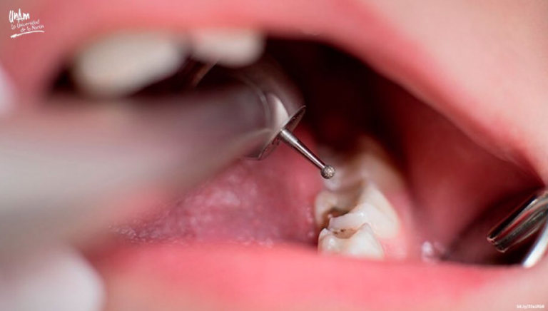 Hay en México 10 millones de niños con caries   