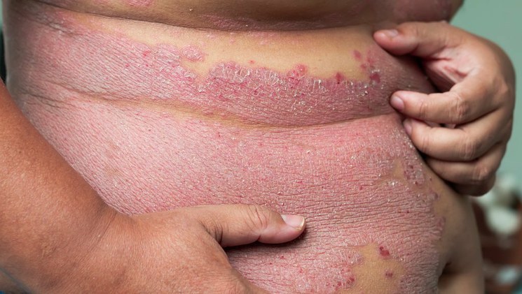 2.5 millones de mexicanos padecen de psoriasis