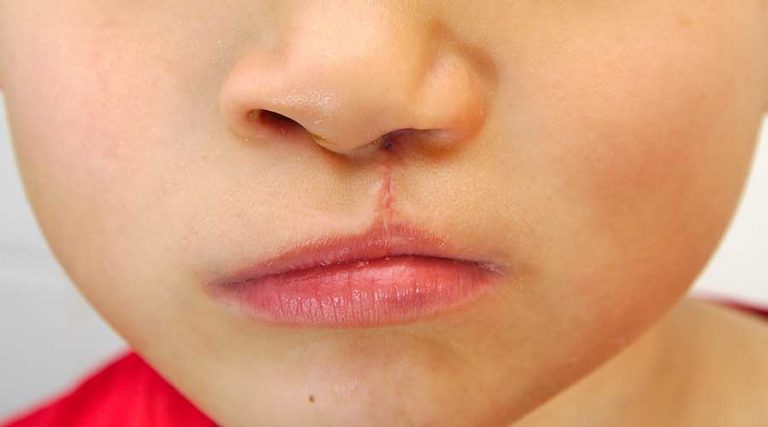 20 Datos sobre Labio y Paladar Hendido