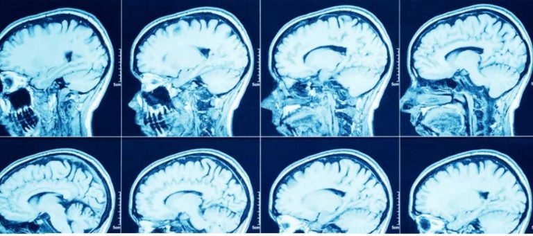 Lesiones Cerebrales por COVID-19, alertan científicos