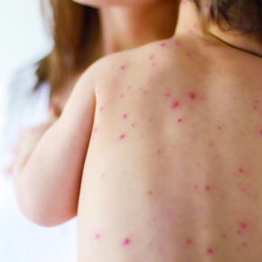 sarampionph01_57749459