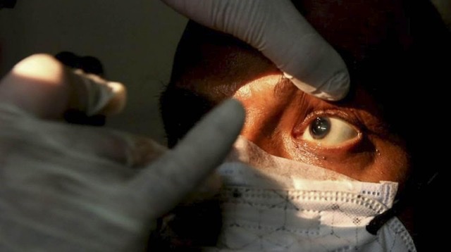 Te contamos del Hongo negro la enfermedad que llegó a México