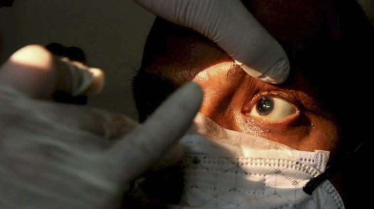 ¿Cuáles son los síntomas del hongo negro?