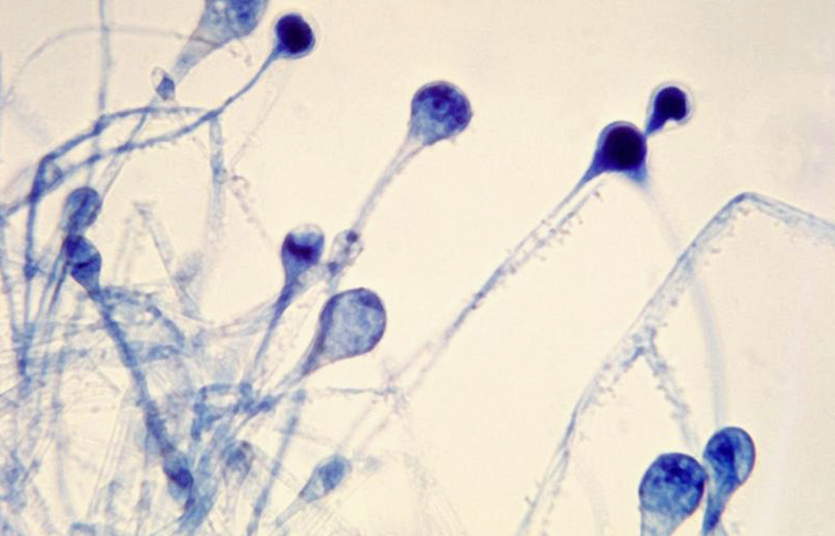 ¿Cuál es el tratamiento para el hongo negro?