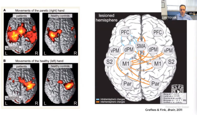 Estudian cómo un infarto cerebral modifica las conexiones neuronales   