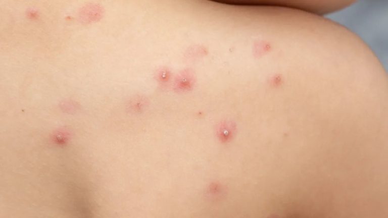 Ocho casos de viruela símica en Aguascalientes