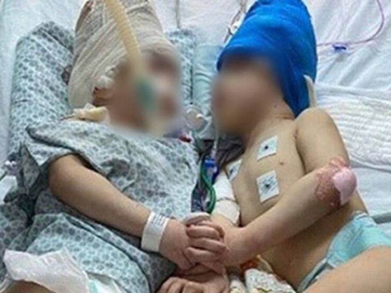 Médicos practicaron con realidad virtual y lograron separar a gemelos unidos por la cabeza