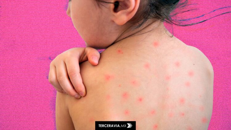 Sarampión en México: 43 casos confirmados y un preocupante rezago en vacunación