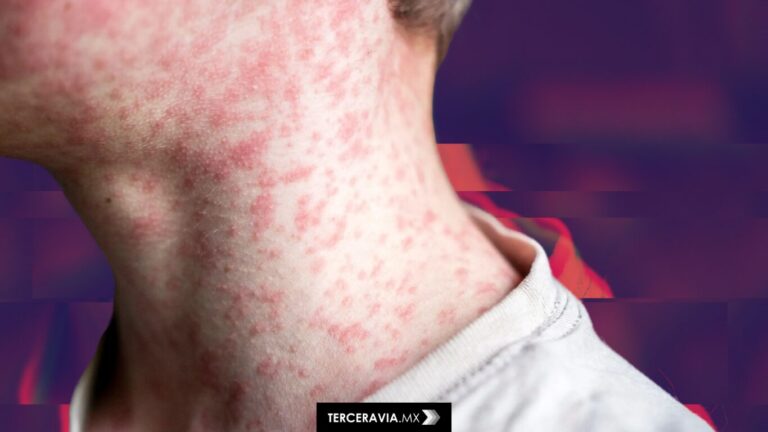 Primera muerte por sarampión en EEUU en 10 años: un brote prevenible que alarma a las autoridades