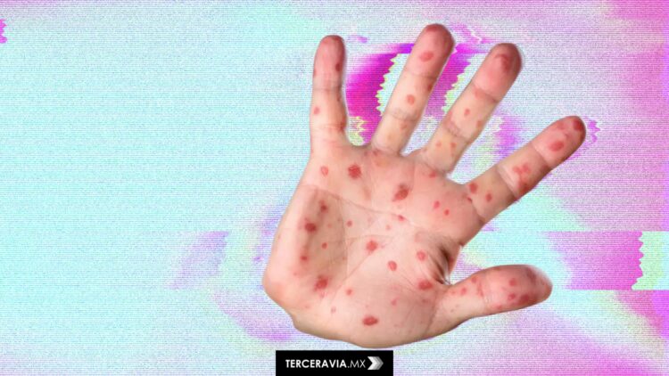 México registra 362 casos de sarampión y una muerte: qué estados tienen casos y por qué urge vacunarse