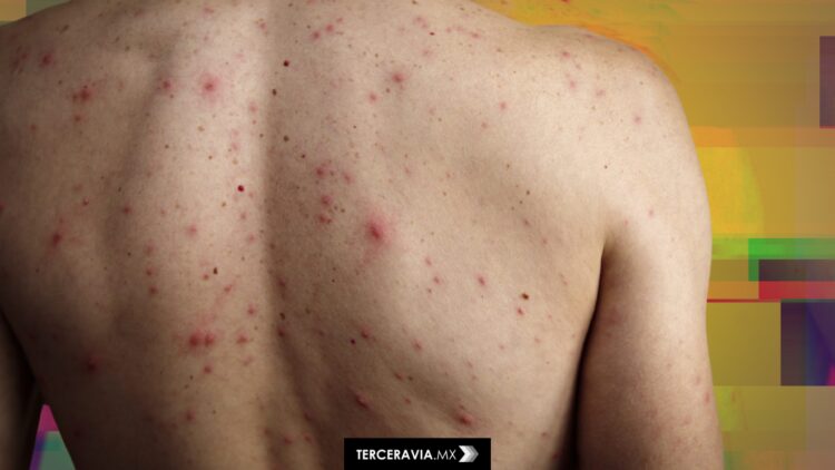 México emite alerta de viaje por brotes de sarampión en EEUU, Canadá y Chihuahua