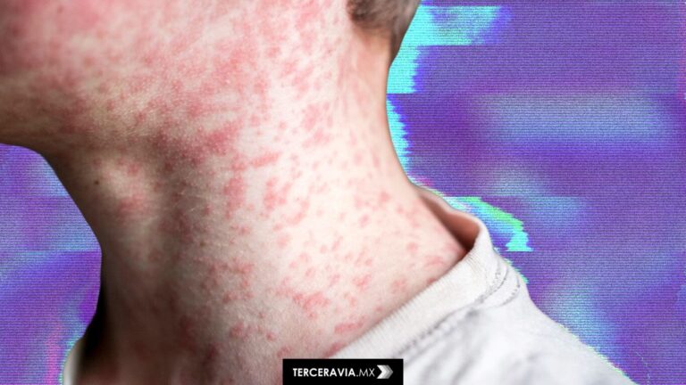 México registra aumento alarmante de casos de sarampión y tosferina: 48 bebés han muerto en 2025