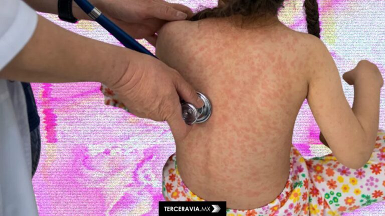 México enfrenta brote de sarampión con foco en migrantes y zonas agrícolas de Chihuahua